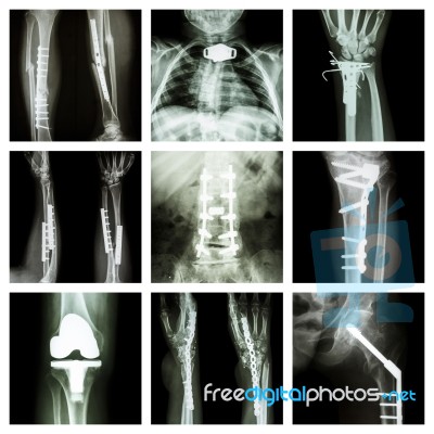 Collection Of Orthopedic Operation Stock Photo