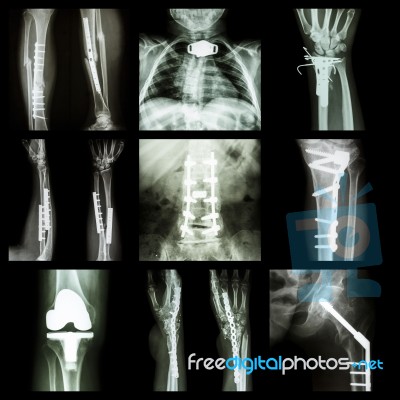 Collection Of Orthopedic Operation Stock Photo