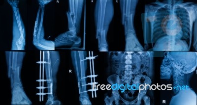 Collection Of  X-ray , Multiple Part Of Adult  Show Fracture Bone And  Disease Stock Photo