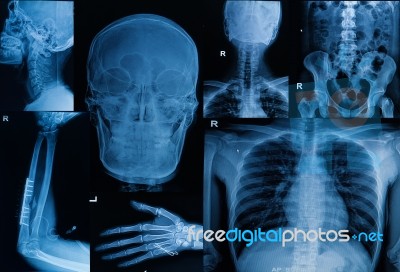 Collection Of  X-ray , Multiple Part Of Adult  Show Fracture Bone And  Disease Stock Photo