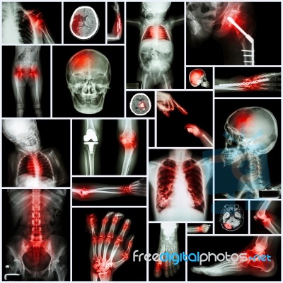 Collection Of X-ray Multiple Part Of Human,orthopedic Operation And Multiple Disease (shoulder Dislocation,stroke,fracture,gout,rheumatoid Arthritis,bronchiectasis,osteoarthritis Knee, Etc ) Stock Photo