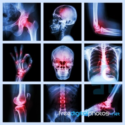 Collection X-ray And Multiple Injury Stock Photo