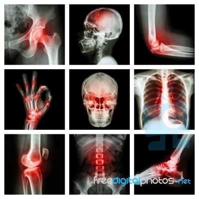 Collection X-ray And Multiple Injury Stock Photo