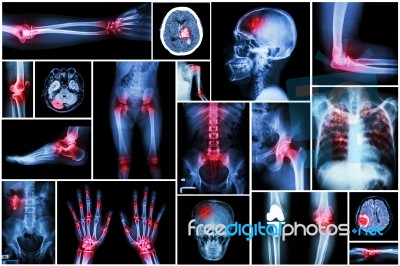 Collection X-ray Multiple Disease (arthritis,stroke,brain Tumor,gout,rheumatoid,kidney Stone,pulmonary Tuberculosis,osteoarthritis Knee, Etc) Stock Photo