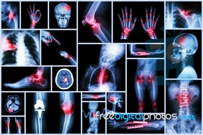 Collection X-ray Multiple Human's Organ & Orthopedic Surgery & Multiple Disease (pulmonary Tuberculosis , Gout , Rheumatoid Arthritis ,spondylosis , Fracture Bone , Stroke , Brain Tumor , Etc) Stock Photo