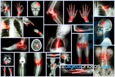 Collection X-ray Multiple Human's Organ & Orthopedic Surgery & Multiple Disease (pulmonary Tuberculosis , Gout , Rheumatoid Arthritis ,spondylosis , Fracture Bone , Stroke , Brain Tumor , Etc) Stock Photo