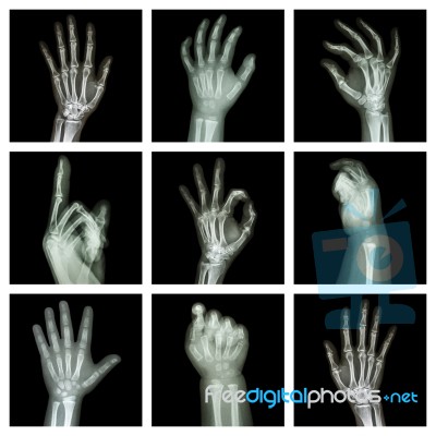 Collection X-ray Of Hands Stock Photo