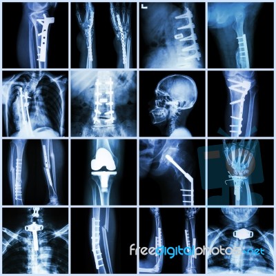 Collection X-ray Orthopedic Surgery (multiple Part Of Human, Operate And Internal Fixation By Plate&screw ) Stock Photo