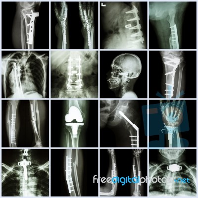 Collection X-ray Orthopedic Surgery (multiple Part Of Human, Operate And Internal Fixation By Plate&screw ) Stock Photo