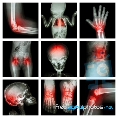 Collection X-ray Part Of Child And Multiple Injury Stock Photo