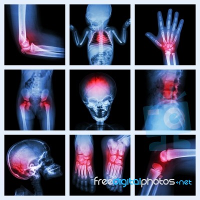 Collection X-ray Part Of Child And Multiple Injury Stock Photo