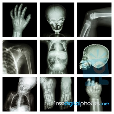 Collection X-ray Part Of Child Body Stock Photo