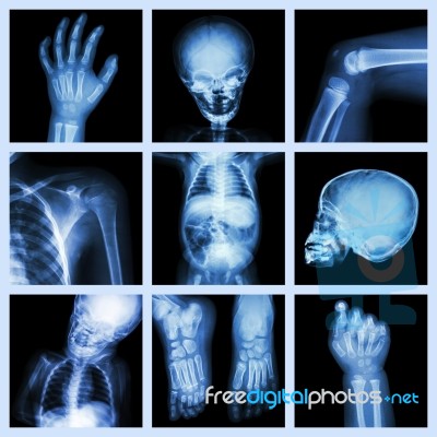 Collection X-ray Part Of Child Body Stock Photo