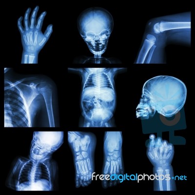 Collection X-ray Part Of Child Body Stock Photo