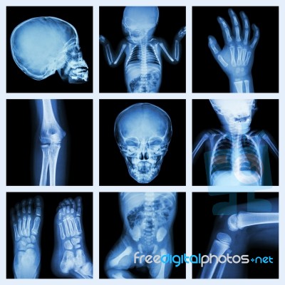 Collection X-ray Part Of Child Body (version 2) Stock Photo