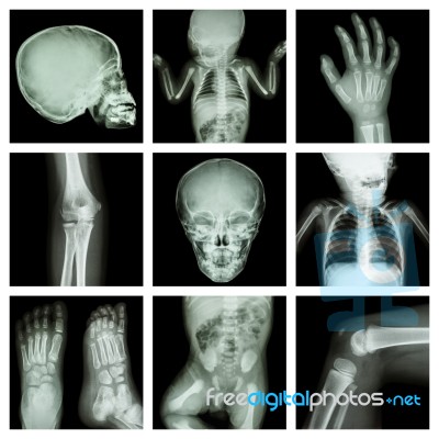 Collection X-ray Part Of Child Body (version 2) Stock Photo