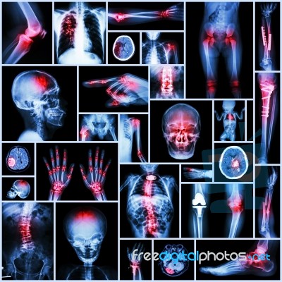 Collection X-ray Part Of Human,orthopedic Operation,multiple Disease (fracture,gout,rheumatoid Arthritis,osteoarthritis Knee,stroke,brain Tumor,scoliosis,tuberculosis, Etc.) Stock Photo