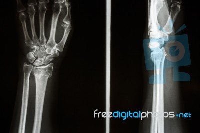 Colles' Fracture Stock Photo