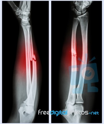 Comminuted Fracture Shaft Of Ulnar Bone Stock Photo