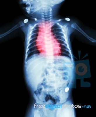 Congenital Heart Disease , Rheumatic Heart Disease ( X-ray Body Of Child And Red Color On Heart Area ) Stock Photo