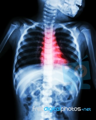 Congenital Heart Disease , Rheumatic Heart Disease ( X-ray Body Of Child And Red Color On Heart Area ) Stock Photo