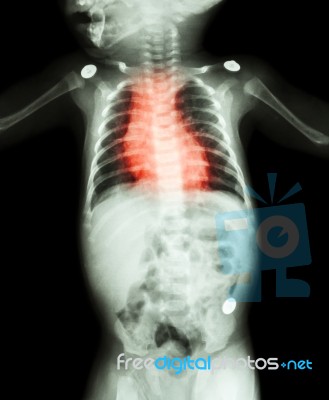 Congenital Heart Disease , Rheumatic Heart Disease ( X-ray Whole Body Of Child And Red Color On Heart Area ) Stock Photo