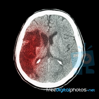 Ct Brain : Show Ischemic Stroke (hypodensity At Right Frontal-pa… Stock Photo