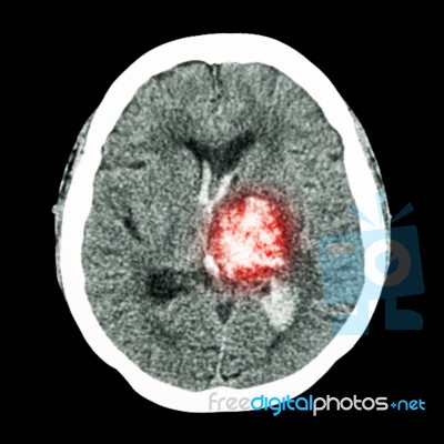 Ct Brain : Show Left Thalamic Hemorrhage (hemorrhagic Stroke) Stock Photo