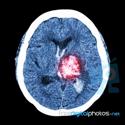 Ct Brain : Show Left Thalamic Hemorrhage (hemorrhagic Stroke) Stock Photo