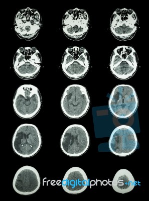 Ct Scan (computed Tomography) Of Brain Show Cerebral Infarction Stock Photo