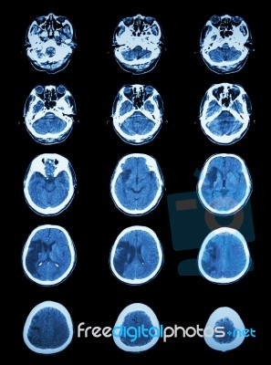 Ct Scan (computed Tomography) Of Brain Show Cerebral Infarction Stock Photo