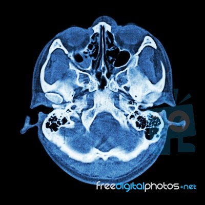 Ct Scan Of Brain And Base Of Skull  ( Bone Window ) Stock Photo