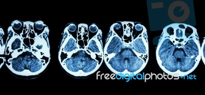 Ct Scan Of Brain And Base Of Skull ( Show Structure Of Eye , Ethmoid Sinus , Cerebellum , Cerebrum, Etc ) Stock Photo