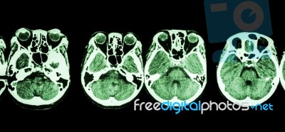 Ct Scan Of Brain And Base Of Skull ( Show Structure Of Eye , Ethmoid Sinus , Cerebellum , Cerebrum, Etc ) Stock Photo