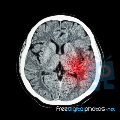 Ct Scan Of Brain Show Ischemic Stroke Or Hemorrhagic Stroke Stock Photo