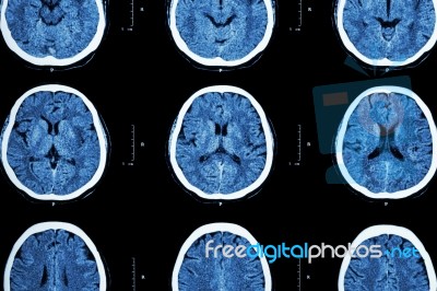 Ct Scan Of Brain Show Normal Brain ( Neurological Background ) Stock Photo