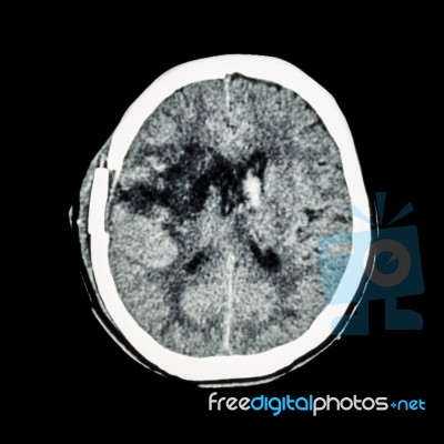 Ct Scan Of Brain : Show Old Right Basal Ganglia Hemorrhage With Brain Edema ( Status Post Craniotomy ) ( Hemorrhagic Stroke ) Stock Photo