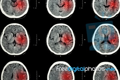 Ct Scan Of Brain With Red Area ( Imaging For Hemorrhagic Stroke Or Ischemic Stroke ( Infarction ) Concept ) Stock Photo