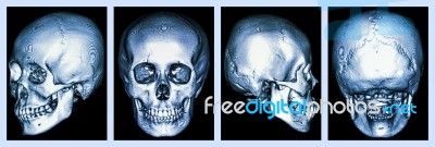 Ct Scan Of Human Skull And 3d Stock Photo