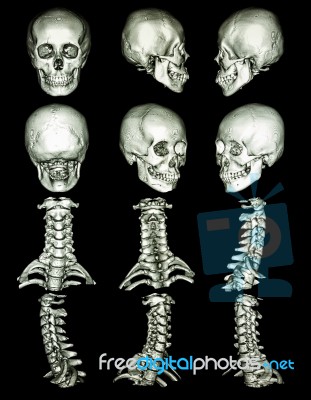 Ct Scan Of Skull Stock Photo