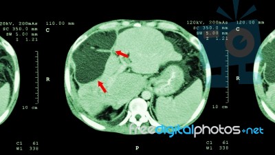 Ct Scan Of Upper Abdomen : Show Abnormal Mass At Liver ( Liver Cancer ) Stock Photo