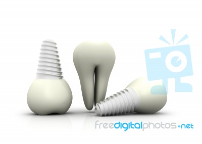 Dental Implant Stock Image