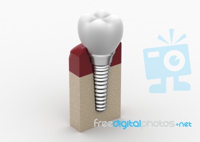 Dental Implantation Stock Image