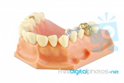 Dental Model (with Different Treatments) Stock Photo