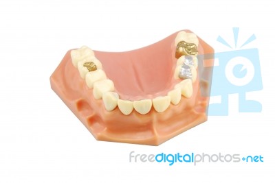 Dental Model (with Different Treatments) Stock Photo