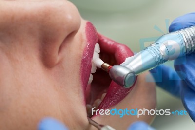 Dental Polishing Treatment Stock Photo