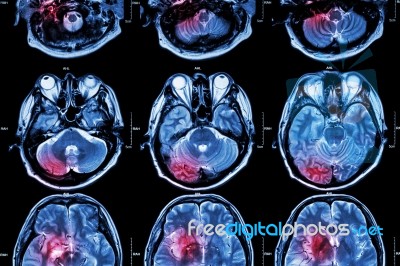 Film Mri ( Magnetic Resonance Imaging ) Of Brain ( Stroke , Brain Tumor , Cerebral Infarction , Intracerebral Hemorrhage )  ( Medical , Health Care , Science Background ) ( Cross Section Of Brain ) Stock Photo