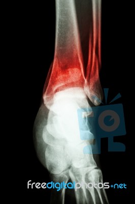 Film X-ray Ankle Show Fracture Distal Tibia And Fibula (leg's Bone) Stock Photo