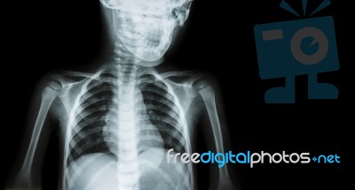 Film X-ray Body Of Child And Blank Area At Right Side ( Medical Background ) Stock Photo