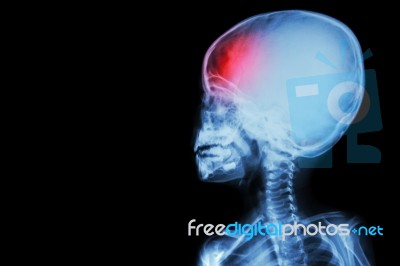 Film X-ray Body Of Child And Headache ( Brain Disease ) ( Isolated ) Stock Photo